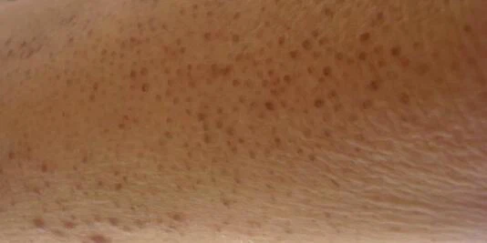 Keratosis pilaris
